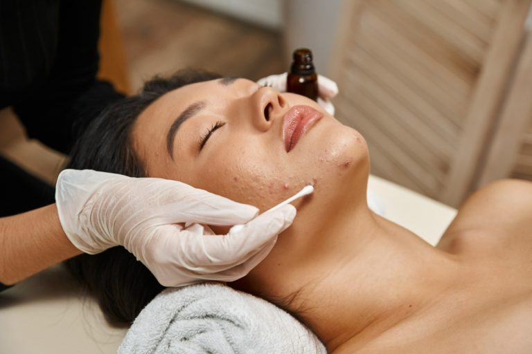 Treatment of Acne in Ayurveda